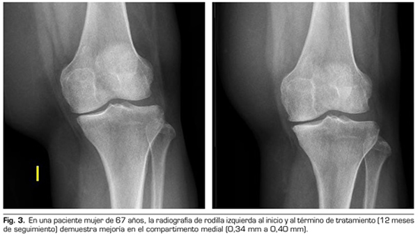 Recomendaciones para los pacientes con artrosis, artritis y dolor crónico  osteomuscular, en tiempos de COVID-19 - Actualidad